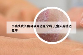 小孩头皮长癣可以用达克宁吗 儿童头藓擦达克宁