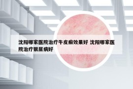 沈阳哪家医院治疗牛皮癣效果好 沈阳哪家医院治疗银屑病好