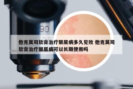 他克莫司软膏治疗银屑病多久见效 他克莫司软膏治疗银屑病可以长期使用吗