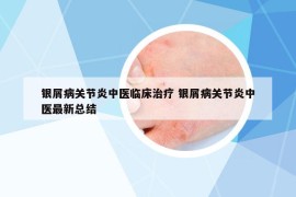 银屑病关节炎中医临床治疗 银屑病关节炎中医最新总结