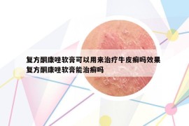 复方酮康唑软膏可以用来治疗牛皮癣吗效果 复方酮康唑软膏能治癣吗