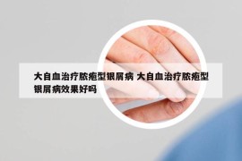 大自血治疗脓疱型银屑病 大自血治疗脓疱型银屑病效果好吗