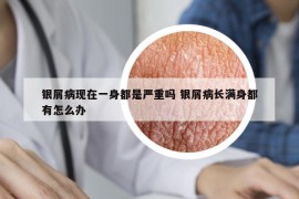 银屑病现在一身都是严重吗 银屑病长满身都有怎么办