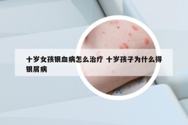 十岁女孩银血病怎么治疗 十岁孩子为什么得银屑病