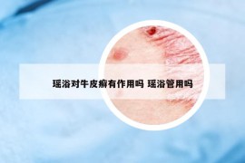 瑶浴对牛皮癣有作用吗 瑶浴管用吗