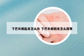 下巴长癣起皮怎么办 下巴长癣脱皮怎么回事