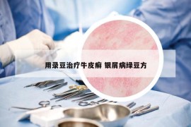 用录豆治疗牛皮癣 银屑病绿豆方