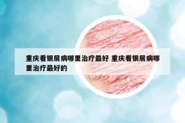 重庆看银屑病哪里治疗最好 重庆看银屑病哪里治疗最好的