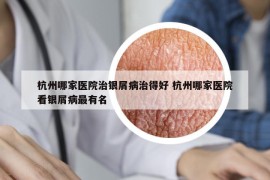 杭州哪家医院治银屑病治得好 杭州哪家医院看银屑病最有名