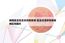 病理亚急性皮炎和银屑病 亚急性湿疹和银屑病区别图片