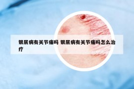 银屑病有关节痛吗 银屑病有关节痛吗怎么治疗