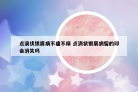 点滴状银屑病不痛不痒 点滴状银屑病留的印会消失吗