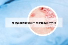 牛皮薛发作如何治疗 牛皮最新治疗方法