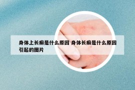 身体上长癣是什么原因 身体长癣是什么原因引起的图片