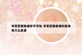 寻常型银屑病并不可怕 寻常型银屑病对身体有什么危害