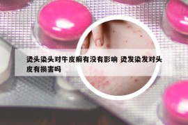 烫头染头对牛皮癣有没有影响 烫发染发对头皮有损害吗