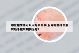 哪些维生素可以治疗银屑病 服用哪些维生素有助于银屑病的治疗?