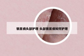 银屑病头部护理 头部银屑病如何护理