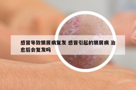 感冒导致银屑病复发 感冒引起的银屑病 治愈后会复发吗