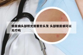 银屑病头部照光需要剪头发 头部银屑病可以光疗吗