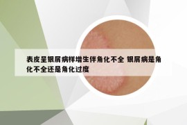 表皮呈银屑病样增生伴角化不全 银屑病是角化不全还是角化过度