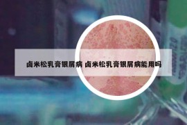 卤米松乳膏银屑病 卤米松乳膏银屑病能用吗