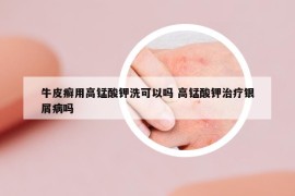 牛皮癣用高锰酸钾洗可以吗 高锰酸钾治疗银屑病吗