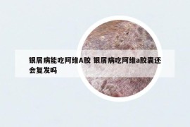 银屑病能吃阿维A胶 银屑病吃阿维a胶囊还会复发吗