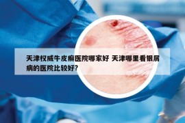 天津权威牛皮癣医院哪家好 天津哪里看银屑病的医院比较好?