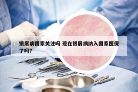 银屑病国家关注吗 现在银屑病纳入国家医保了吗?