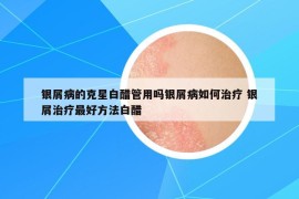 银屑病的克星白醋管用吗银屑病如何治疗 银屑治疗最好方法白醋