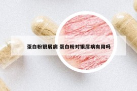 蛋白粉银屑病 蛋白粉对银屑病有用吗