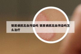 银屑病抓出血传染吗 银屑病抓出血传染吗怎么治疗