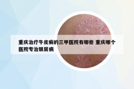 重庆治疗牛皮癣的三甲医院有哪些 重庆哪个医院专治银屑病