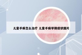 儿童手癣怎么治疗 儿童手癣早期症状图片