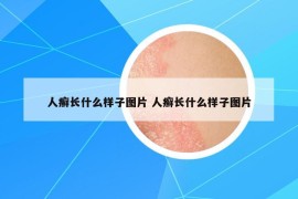 人癣长什么样子图片 人癣长什么样子图片