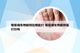 银屑病生物制剂在哪能打 银屑病生物制剂是打针吗