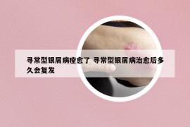 寻常型银屑病痊愈了 寻常型银屑病治愈后多久会复发