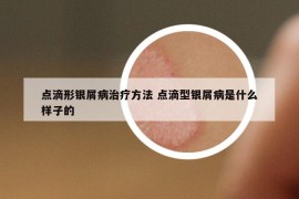 点滴形银屑病治疗方法 点滴型银屑病是什么样子的