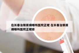 在长春治银屑病哪所医院正规 在长春治银屑病哪所医院正规些