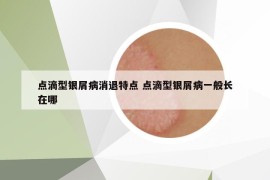 点滴型银屑病消退特点 点滴型银屑病一般长在哪