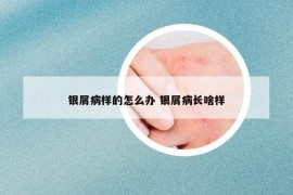 银屑病样的怎么办 银屑病长啥样