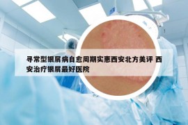 寻常型银屑病自愈周期实惠西安北方美评 西安治疗银屑最好医院