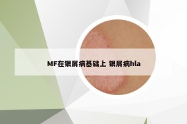 MF在银屑病基础上 银屑病hla