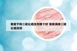 银屑宁和二硫化硒洗剂那个好 银屑病用二硫化硒洗剂