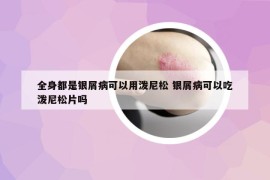 全身都是银屑病可以用泼尼松 银屑病可以吃泼尼松片吗