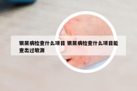 银屑病检查什么项目 银屑病检查什么项目能查出过敏源