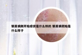 银屑病刚开始症状是什么样的 银屑病初始是什么样子