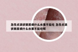 急性点滴状银屑病什么水果不能吃 急性点滴状银屑病什么水果不能吃呢