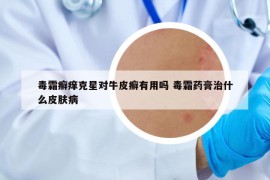 毒霜癣痒克星对牛皮癣有用吗 毒霜药膏治什么皮肤病